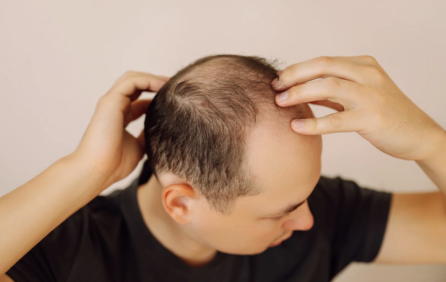 Male hair loss treatment